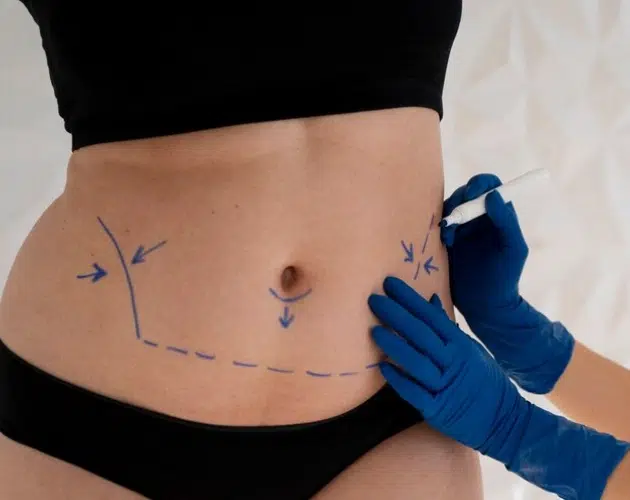Cirugía Abdominoplastia