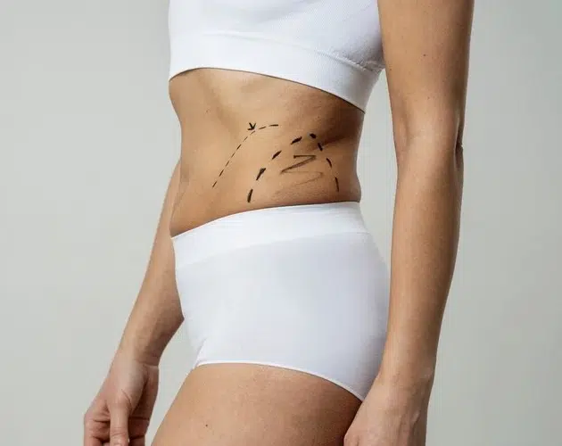 Cirugía Abdominoplastia