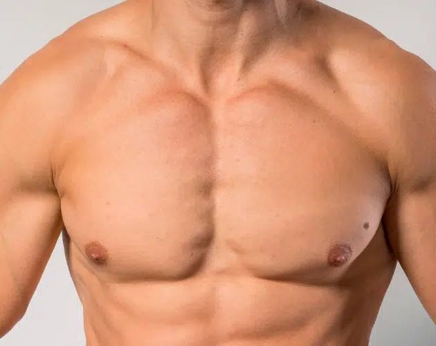 Cirugía Ginecomastia