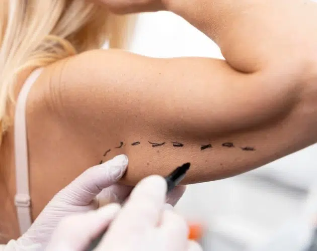 Lipoescultura plástica